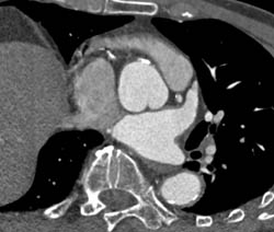 Dilated Aortic Root - CTisus CT Scan