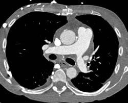 Collaterals Due to SVC Stenosis - CTisus CT Scan