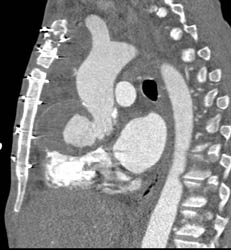 Pseudoaneurysm Root of Aorta - CTisus CT Scan