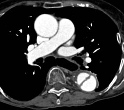 Pseudo Dissection of Descending Thoracic Aorta- See Full Sequence - CTisus CT Scan