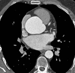 Dilated Aortic Root and Marfan Syndrome - CTisus CT Scan