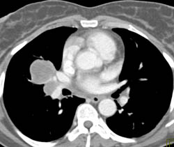 Lung Cancer With Adrenal Metastases and Left Renal Vein Thrombosis - CTisus CT Scan