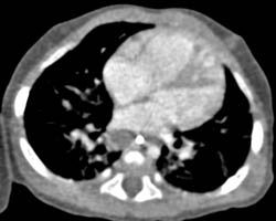 Subcarinal Nodes Due to Tuberculosis (TB) - CTisus CT Scan