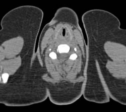 Tracheal Stenosis Due to Traumatic Intubation in Multiple Projections - CTisus CT Scan