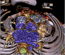 Para-cardiac Nodes - CTisus CT Scan