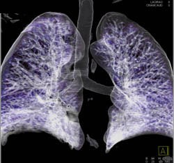 Patent Virtual Bronchoscopy With Dilated Trachea - CTisus CT Scan