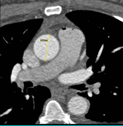 Air in Pulmonary Artery- Need to Avoid - CTisus CT Scan