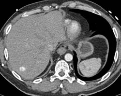 Post Right Pneumonectomy - CTisus CT Scan