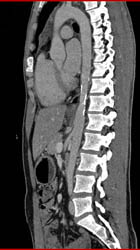 Calcified Aorta at Diaphragm Secondary to Old Trauma - CTisus CT Scan