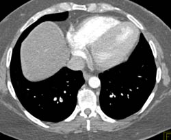 Incidental Pe- Right Lower Lung - CTisus CT Scan