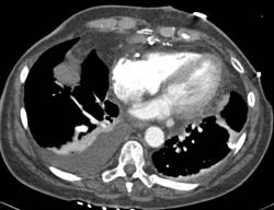 Pulmonary Embolism (PE) in Left Lower Lung - CTisus CT Scan