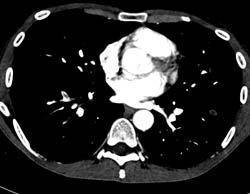 Pulmonary Embolism (PE) in Right Lower Lung With Right Renal Infarction - CTisus CT Scan