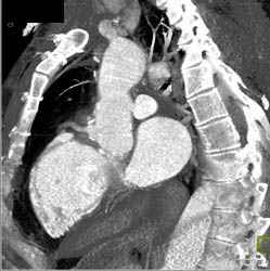 Aortic Dissection - CTisus CT Scan