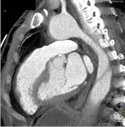 Aortic Dissection - CTisus CT Scan