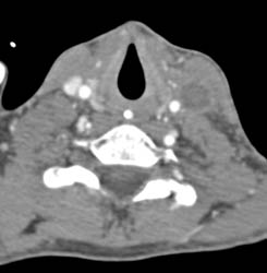 Jugular Vein Thrombosis on Left - CTisus CT Scan