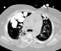 High Density Nodules in Lung Probably Due to Tuberculosis (TB) - CTisus CT Scan