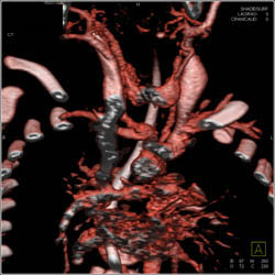 Tracheal Stenosis Due to Traumatic Intubation - CTisus CT Scan