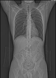 Pectus Deformity - CTisus CT Scan