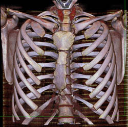 Pectus Deformity - CTisus CT Scan