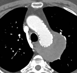 Repair of Arch Aneurysm With Stent and Vessel Tracking - CTisus CT Scan