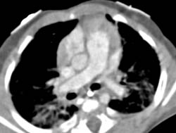 Prominent Flow Through Azygos - CTisus CT Scan