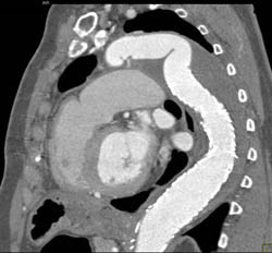 Dilated Right Subclavian Artery - CTisus CT Scan