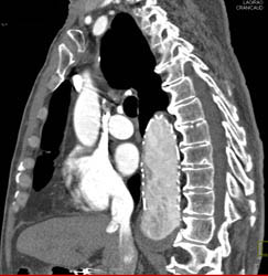 Stent in Descending Aorta - CTisus CT Scan