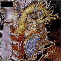 Normal CCTA - CTisus CT Scan