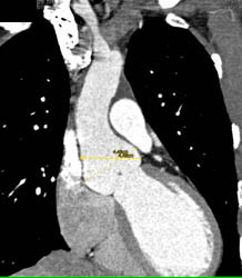 Dilated Sinus of Valsalva- Marfan Syndrome - CTisus CT Scan