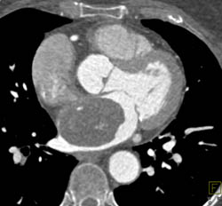 Atrial Myxoma in Multiple Visualizations - CTisus CT Scan