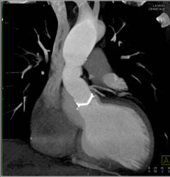 Repair of Aortic Root and Ascending Aorta With Valve Replacement - CTisus CT Scan