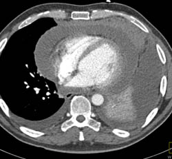 Lymphoma With Pericardial Effusion - CTisus CT Scan