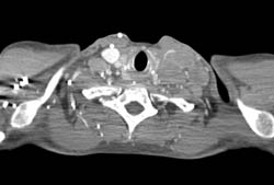 Metastatic Sarcoma With Left Jugular Vein Thrombosis and Extensive Nodes and Tumor Implants - CTisus CT Scan