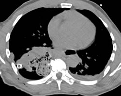 Retained Sponge in Right Chest - CTisus CT Scan