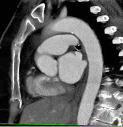 Minimal Plaque in Arch - CTisus CT Scan