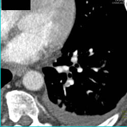 Pe - CTisus CT Scan