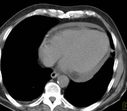 Pericardial Thickening - CTisus CT Scan