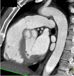 Defined Pulmonary Valve - CTisus CT Scan