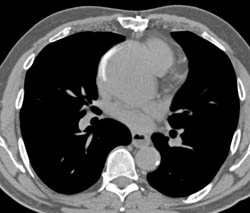 Aortic Dissection With Decreased Function Left Kidney - CTisus CT Scan