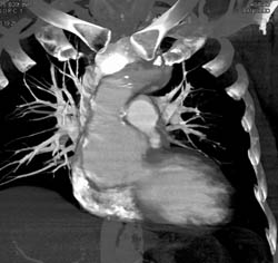 Dilated Aortic Root in Marfan Syndrome - CTisus CT Scan