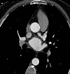 Normal Aortic Valve Replacement in 3D- See Full Sequence - CTisus CT Scan