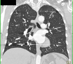 Prior Pulmonary Arteriovenous Malformation (PAVM) Embolization in Right Lower Lobe With Few Left PAVMs - CTisus CT Scan