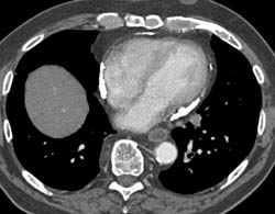 Calcified Pericarditis - CTisus CT Scan