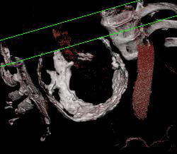 Calcific Pericarditis- Impressive Pericardial Calcification - CTisus CT Scan