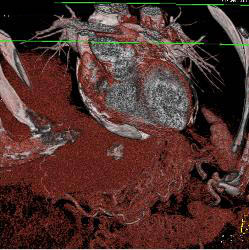 Calcific Pericarditis- Impressive Pericardial Calcification - CTisus CT Scan