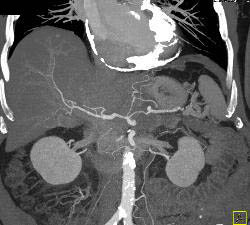 Calcific Pericarditis- Impressive Pericardial Calcification - CTisus CT Scan