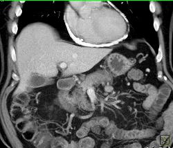 Calcific Pericarditis- Impressive Pericardial Calcification - CTisus CT Scan