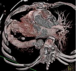 Shunt Between Left Ventricle and Descending Aorta in Patient With Poor Lv Function - CTisus CT Scan