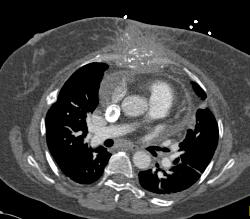 Post Mediastinal Surgery With Osteomyelitis - CTisus CT Scan