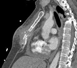 Post Mediastinal Surgery With Osteomyelitis - CTisus CT Scan